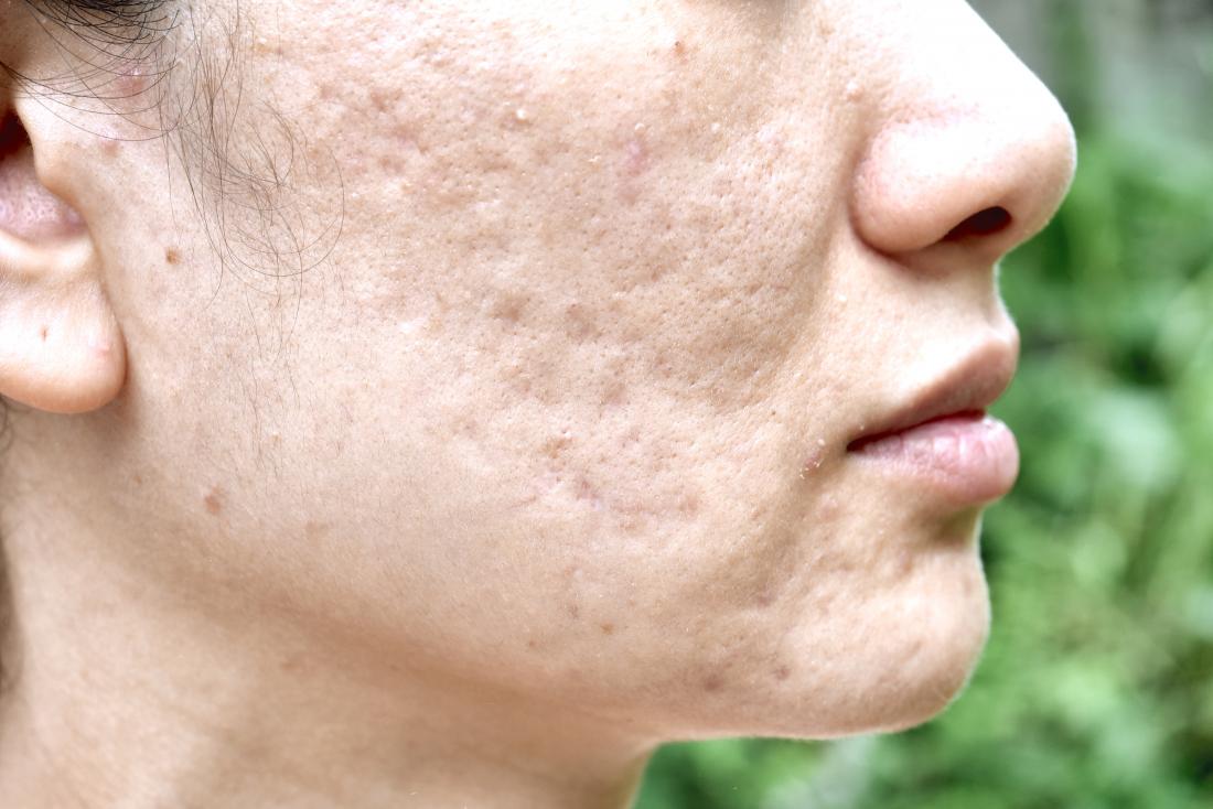 Side profile of person with acne scars