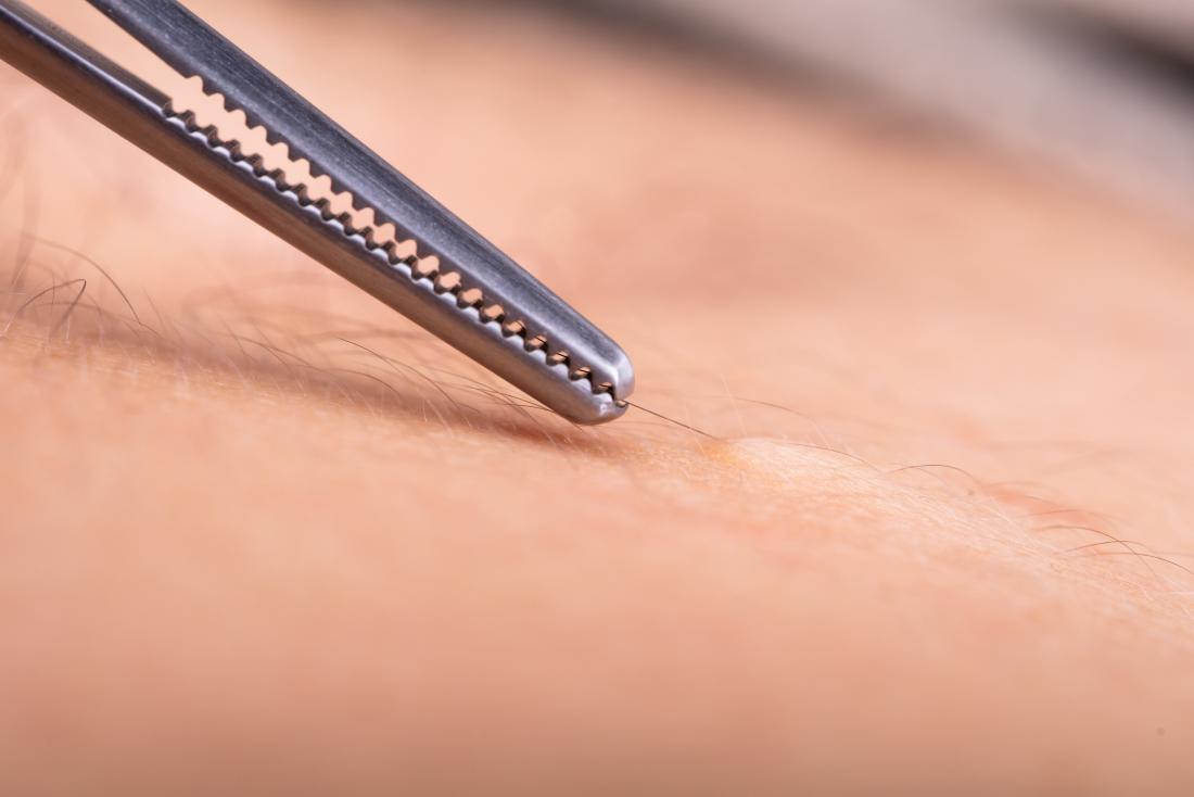 Tweezers pulling at hair