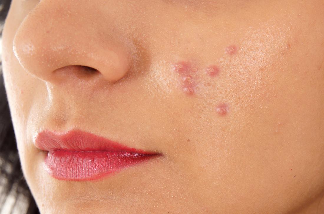 pustules pimples