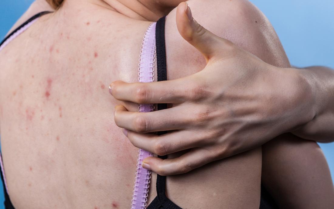 a woman scratching her back because of itcy acne. 